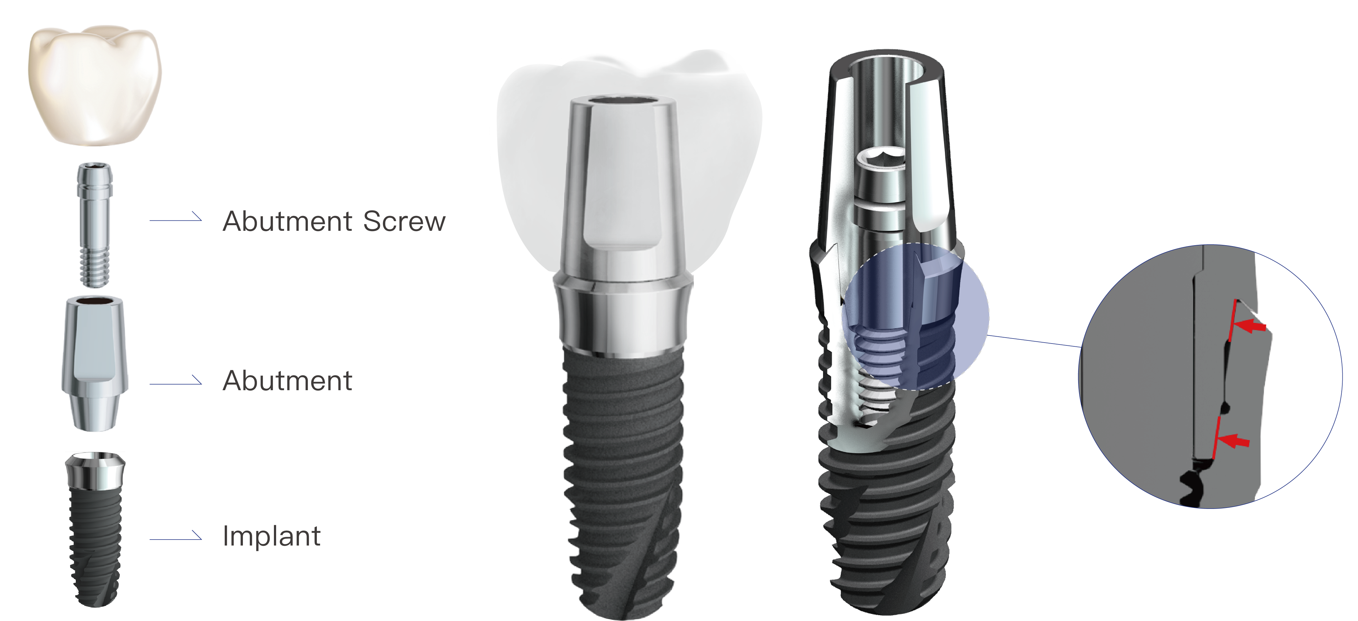 The design of two connections between implant and abutment ensures